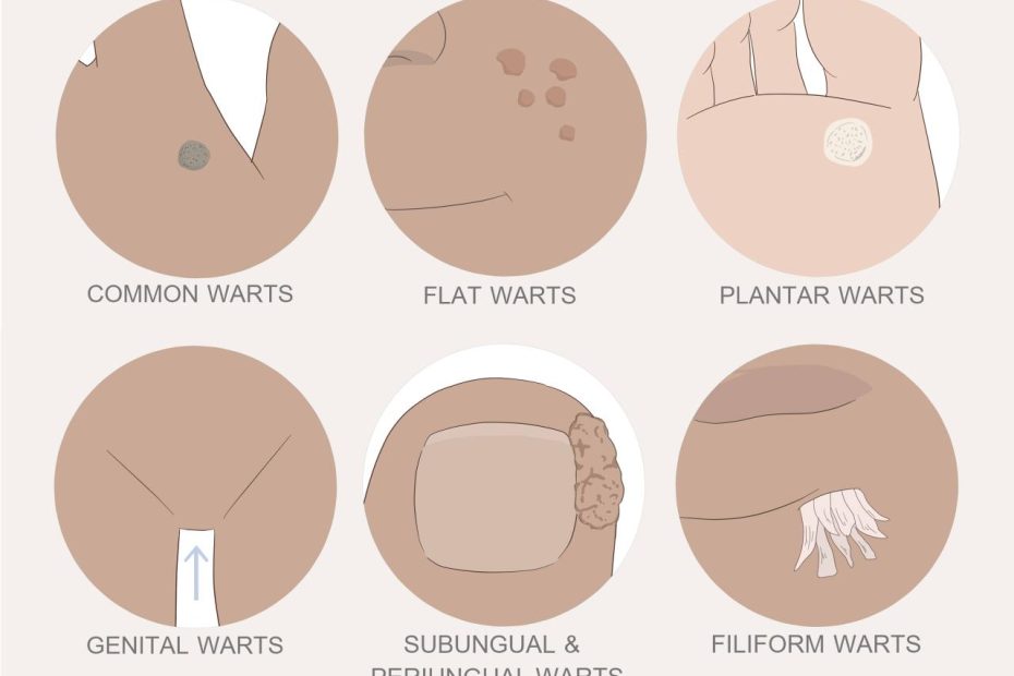 5 Ways To Get Rid Of Warts - Wikihow